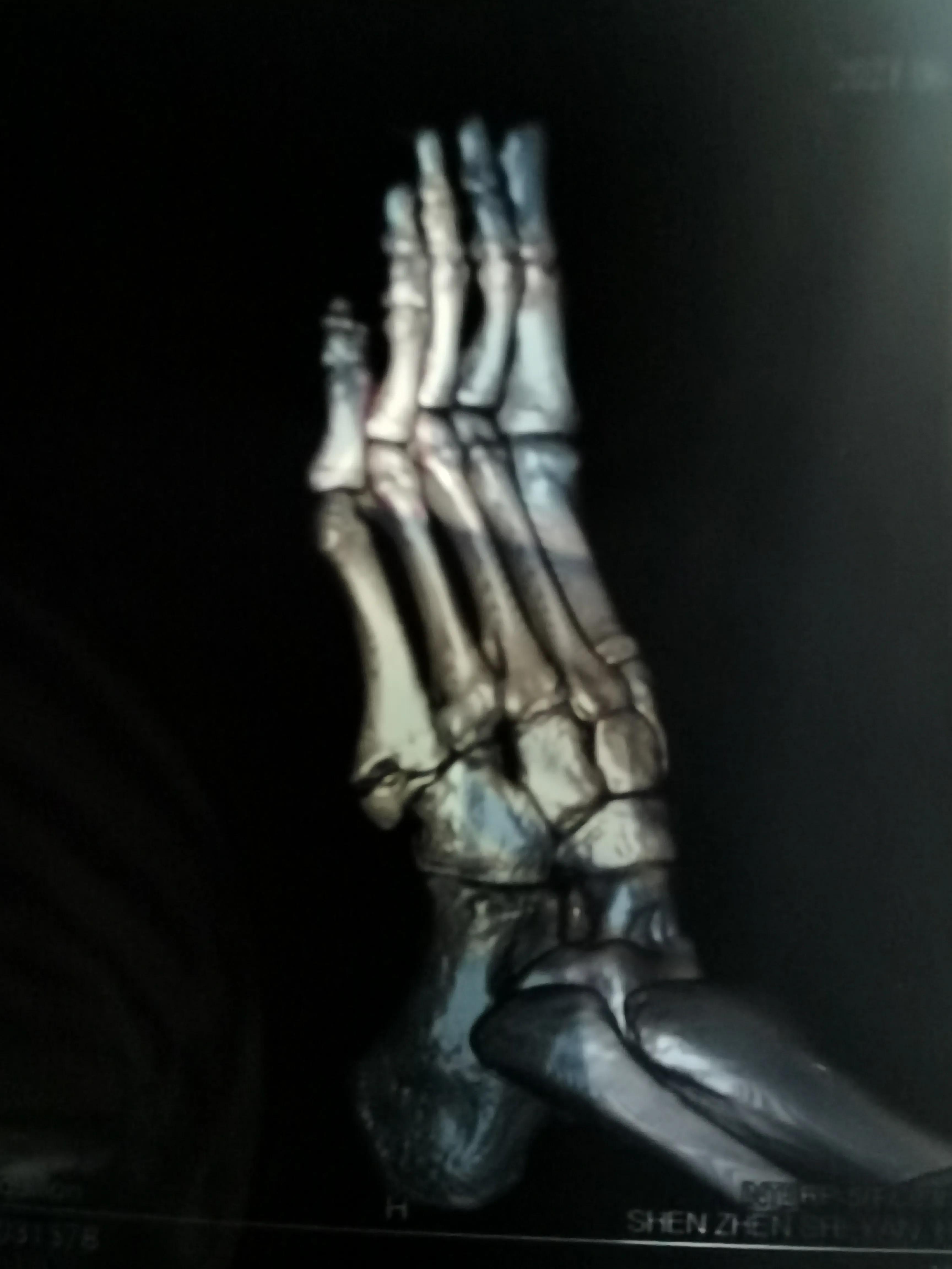 第五跖骨基底部骨折60天能走路吗,第五跖骨基底部骨折60天能脱拐吗