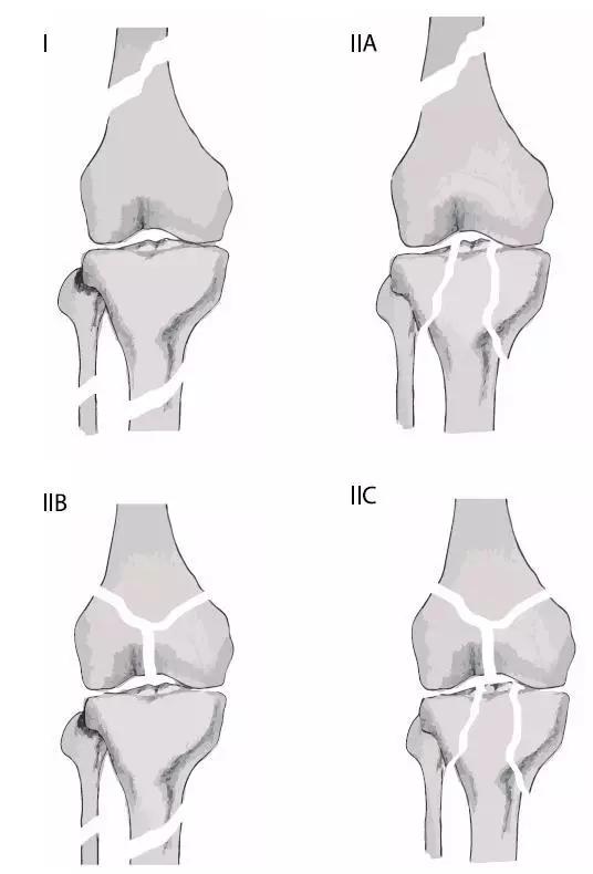 几种严重骨折医学名称,常见的骨折有哪些名称