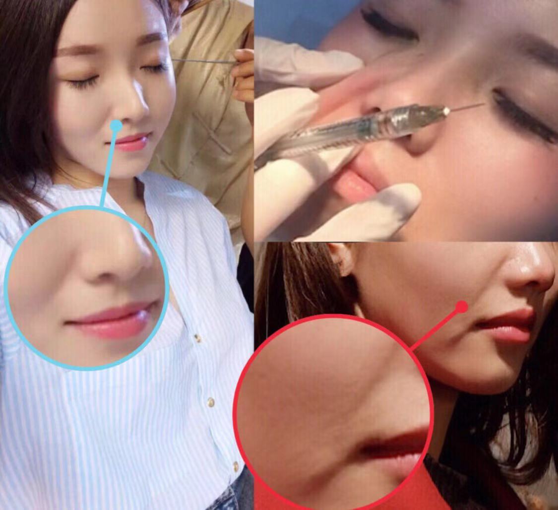 瘦脸针一年后出现后遗症如何补救,瘦脸针的后遗症失败案例图片