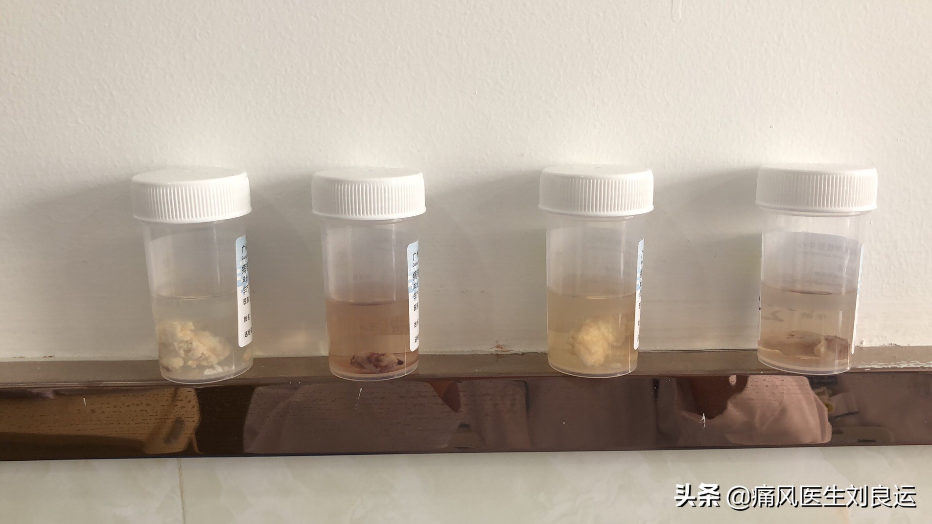 四十岁的男人尿酸高要注意什么,男50岁尿酸高注意点啥