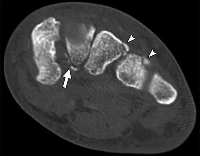 骨折处出现麻痹感,骨折跟精神状态有关