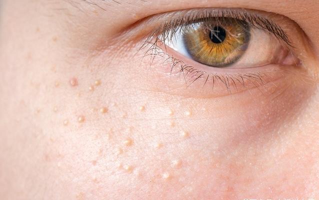 如何快速祛痘:痘痘分四个等级,你属于哪一级?