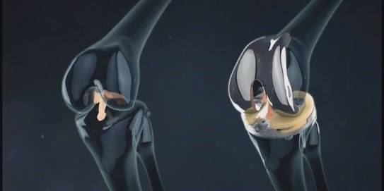 关节炎可以通过打抗生素治疗吗,关节炎治疗的注意事项