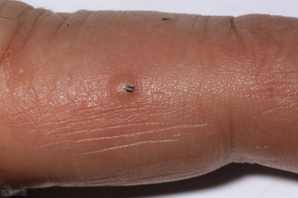 手背上起茧用鸡眼膏,老人脚上长了鸡眼后脚溃烂