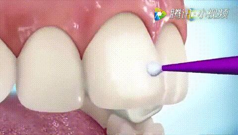 矫正科普15秒,科普矫正