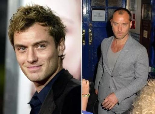 小贝为何剃光头,贝克汉姆的头秃