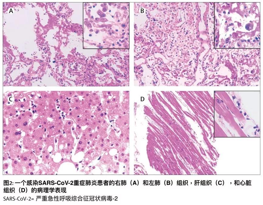 新冠肺炎的病理解剖图,全球首例新冠肺炎尸检结果