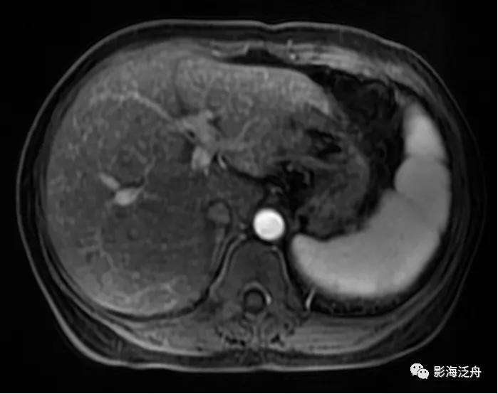 肝脏弥漫性病变严重吗,肝脏弥漫性的病变的症状