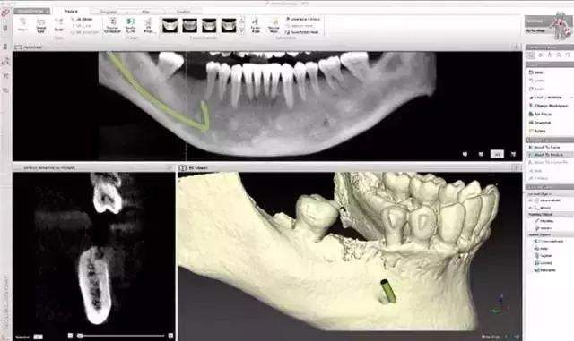 缺失牙公益广告韩国,缺失牙修复的视频