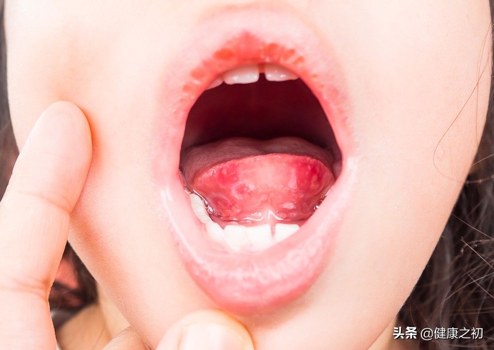 干燥综合征牙齿烂了怎么办,口干牙齿坏一定是干燥综合症吗