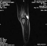 膝盖后面有个鼓鼓的包是不是病,膝盖后面有个包怎么回事