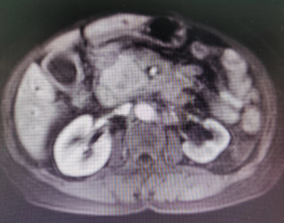 胰腺癌病人后期要注意些什么,胰腺癌没转移切除可以长期生存吗