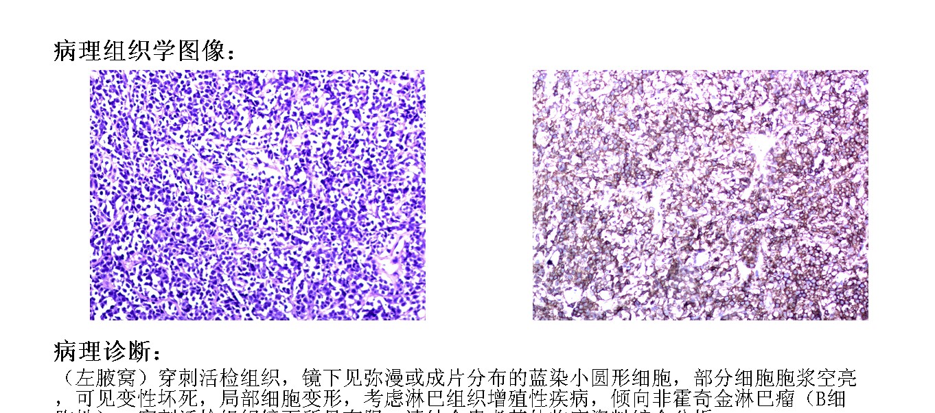 男38岁后背靠腋下内侧有一硬块,男孩腋窝底下有包块
