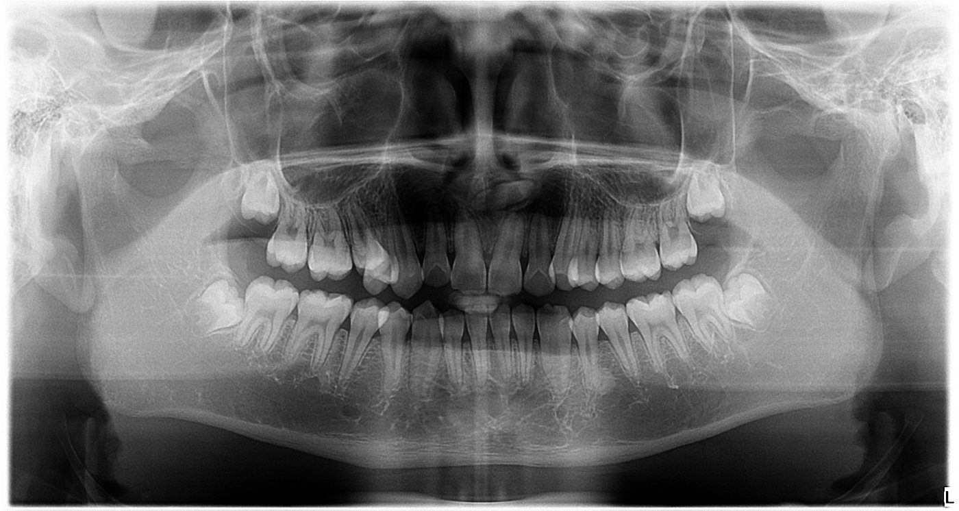 正规的北京牙齿矫正方案,牙齿矫正北京口腔医院