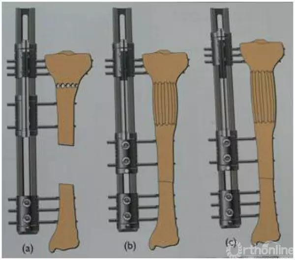 外固定支架训练方法,外固定支架拆除后怎么护理