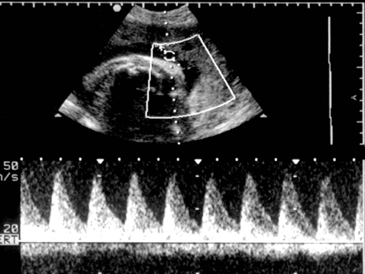 脐带过长超声诊断,脐带过长或过短能检查出来吗