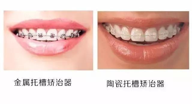 牙齿矫正必须先拔掉智齿嘛,牙齿矫正一定要先补牙吗