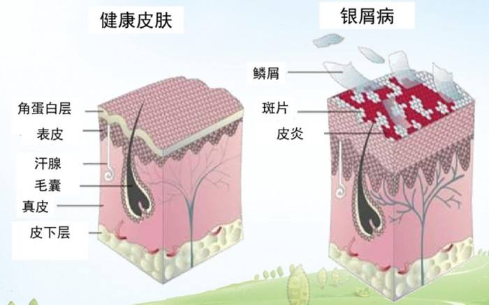 曾国藩的皮肤病是银屑病吗,曾国藩银屑病原因