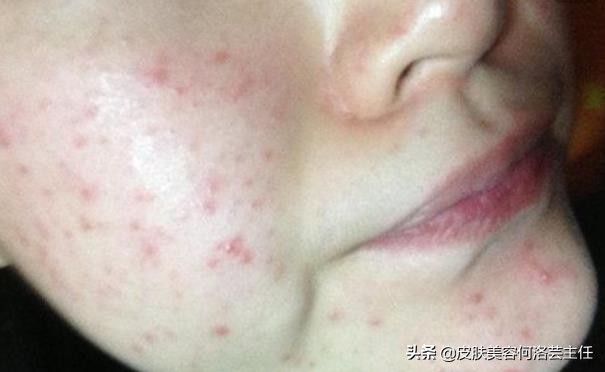 疮疡病的症状及治疗方法,生疮的症状和治疗方法