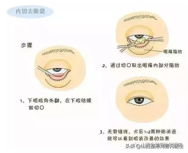 46岁做眼袋还需要做卧蚕吗,现在都把眼袋叫卧蚕了吗
