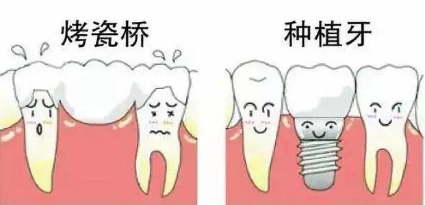 种植牙和烤瓷牙的利弊有哪些,种植牙和烤瓷牙的区别哪个更坚固