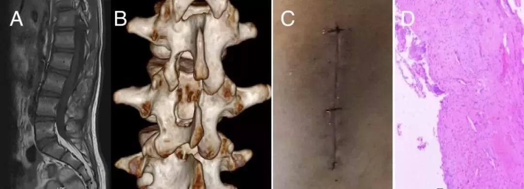 腰椎管内畸胎瘤能不能彻底治愈,腰椎管狭窄加脊柱侧弯怎么治疗