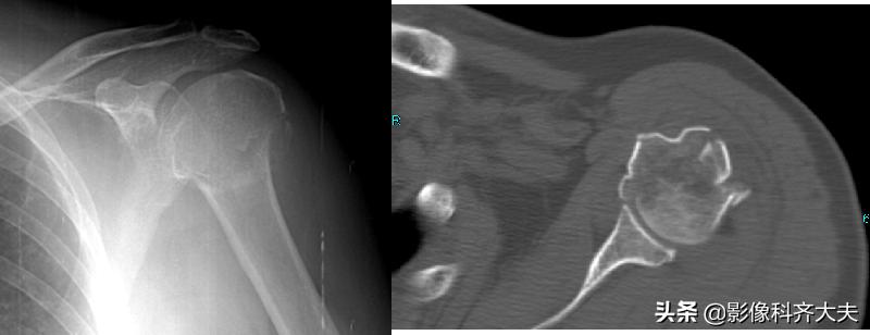 骨折的影像学检查及各自的优势,骨折的影像学愈合标准