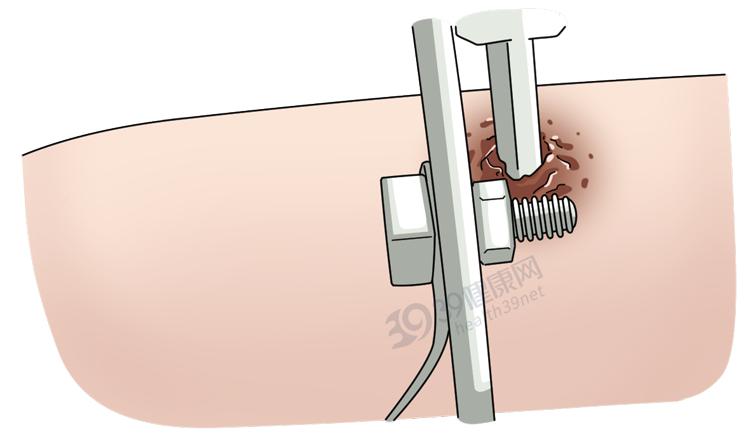 做断骨增高的人怎么样了,做了断骨增高看得出来吗