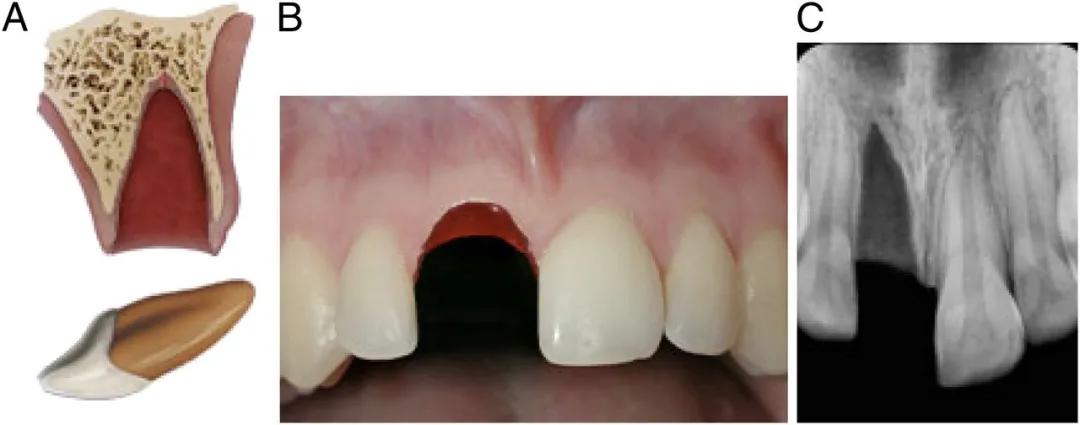 宝宝磕到牙会伤到神经吗,宝宝磕掉乳牙还能再长吗