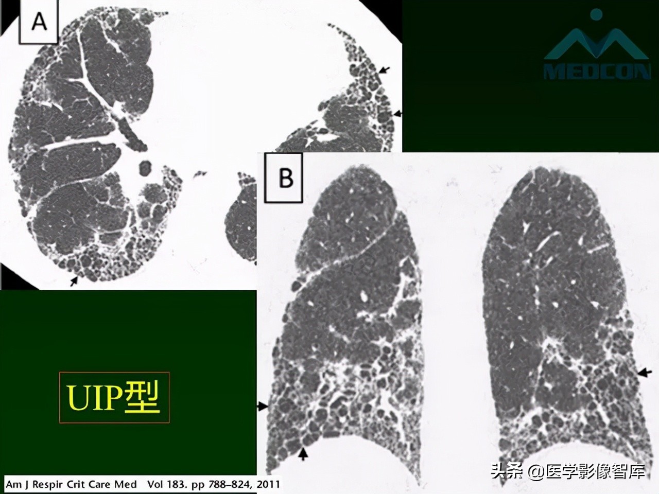 肺弥漫性网状影,两肺小叶间隔增厚可见网状模糊影
