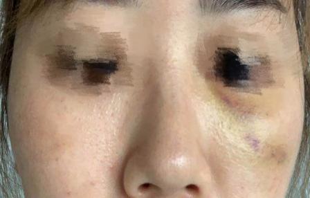 一次水光针相当于敷了1000次面膜,一次水光针等于10次补水