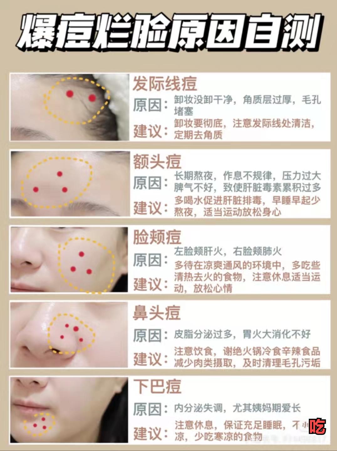 脸上反反复复长痘油腻是怎么回事,脸上反反复复长有脓的痘怎么回事