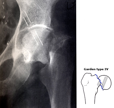 真实有效治疗骨折的方法,这几种骨折一定要注意