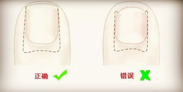 甲沟炎怎么自己修剪,甲沟炎修剪过程怎么缓解疼痛