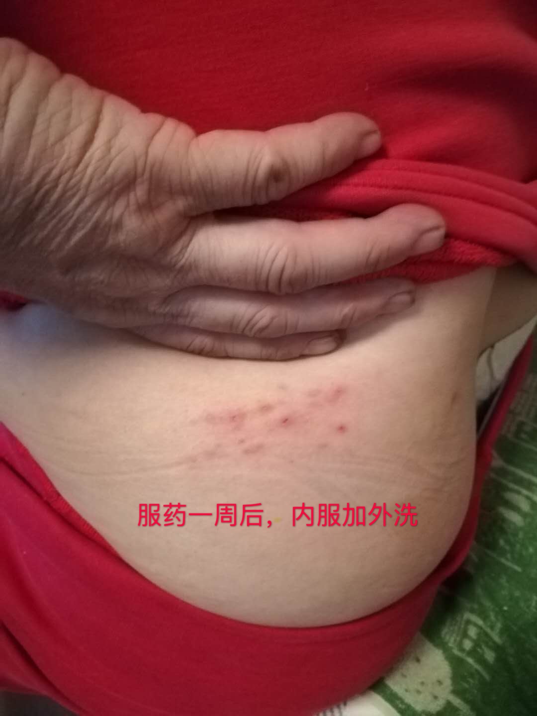 蛇缠腰带状疱疹的后遗症中医治疗,带状疱疹后遗症特效中医针灸治疗