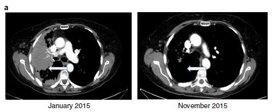 如何选择最好的靶向药？基因表达很重要