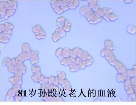 血液粘稠的病因及治疗,健康血液粘稠别小看但也别乱治