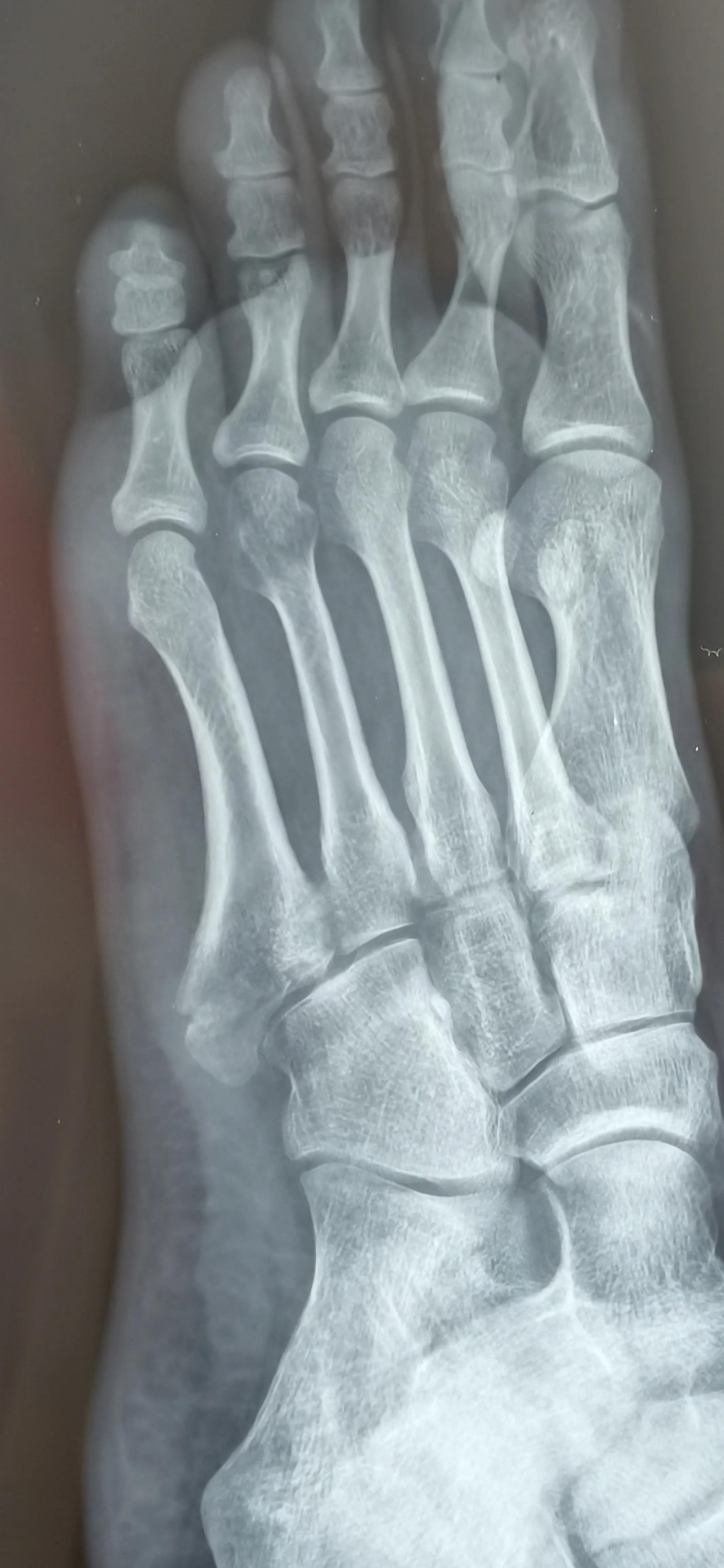 第五跖骨粉碎性骨折多久后能走路,第五跖骨基底骨折100天了走路肿