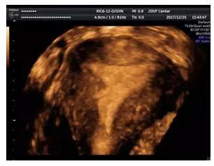 三维超声对宫腔粘连评估的重要性