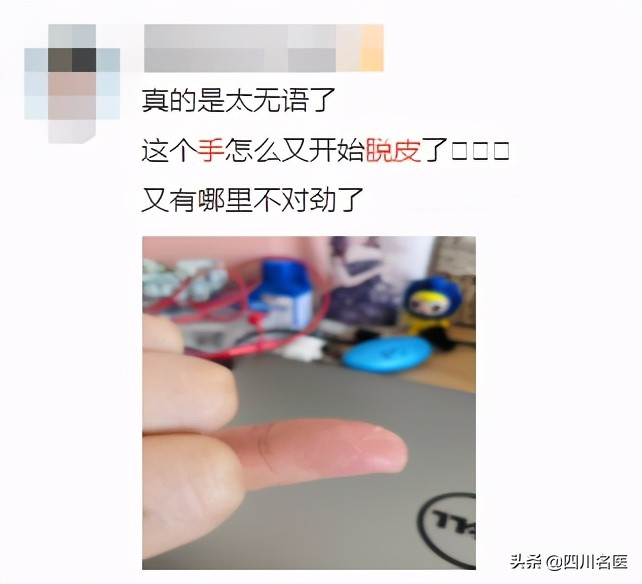 你的手指上为什么会脱皮,您的手为什么会脱皮