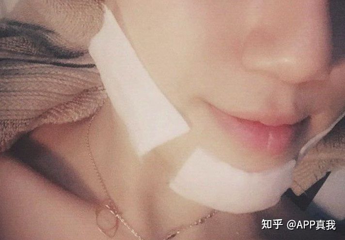 刷酸对闭口粉刺有用吗,刷酸可以解决闭口粉刺吗