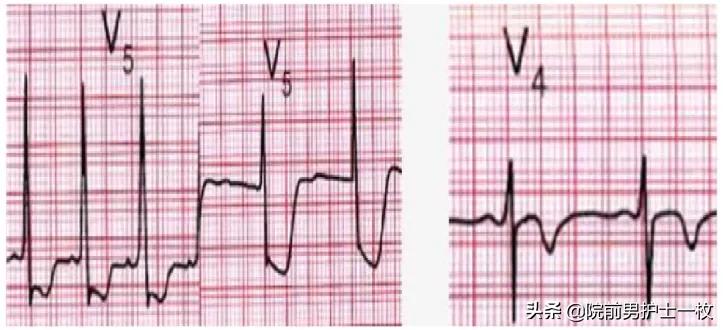 急性心梗的紧急处理视频,一旦发现急性心梗如何救