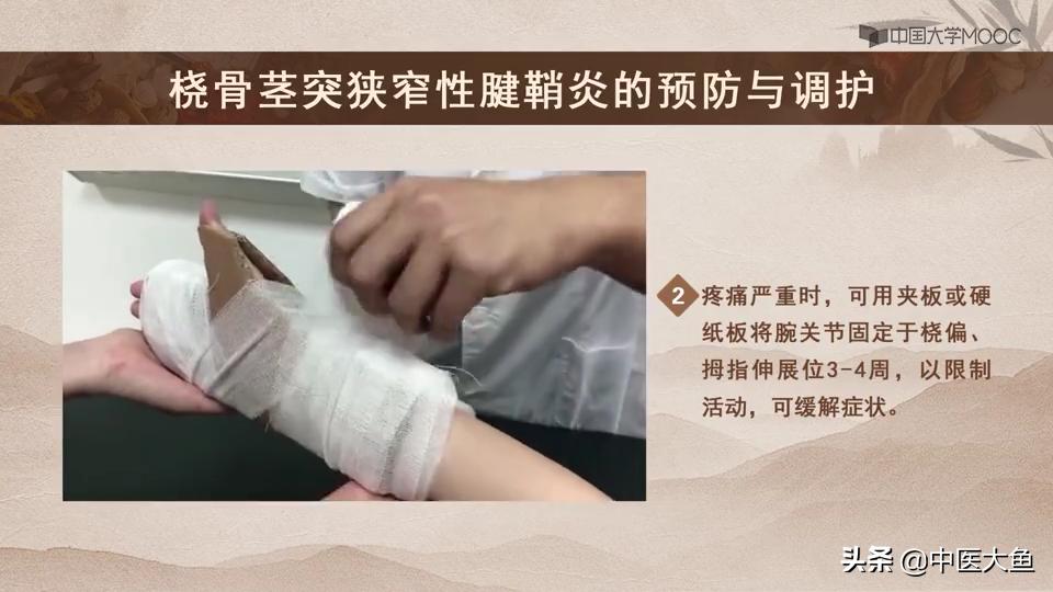 桡骨茎突狭窄性腱鞘炎怎么治疗,桡骨茎突狭窄性腱鞘炎治疗方法