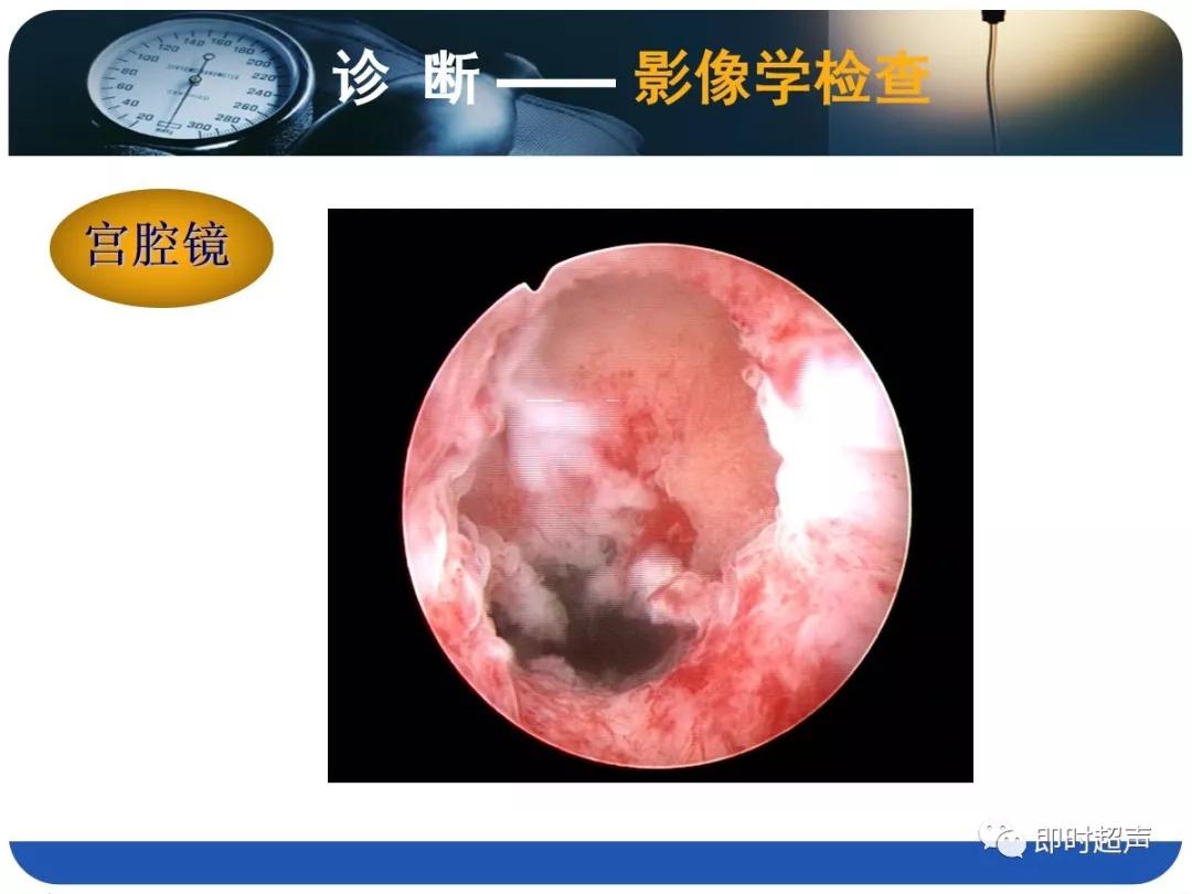 孕妇剖宫产瘢痕憩室,剖宫产瘢痕憩室息肉