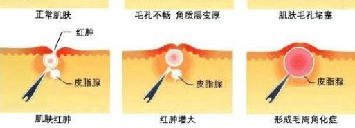 护理鸡皮肤的正确方法,身上的鸡皮肤怎样才能彻底消除