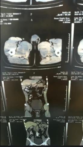 用命换钱的“骡子，是如何把大量*品毒**塞进自己体内的？