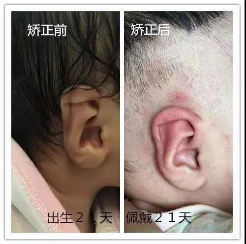 耳廓畸形高考生体检怎么办,二度耳廓畸形矫正方案