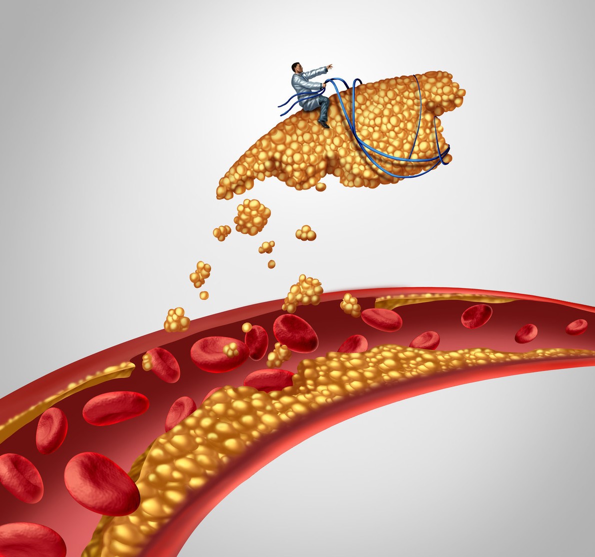 颈动脉斑块与阿司匹林,颈动脉斑块吃他汀还是阿司匹林好