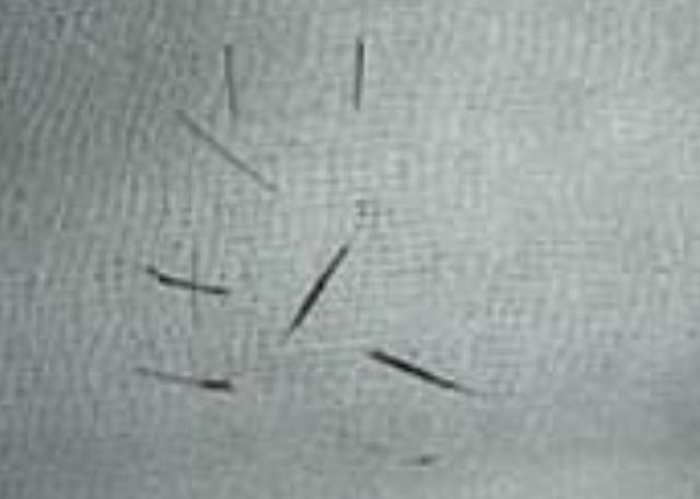 女孩牙龈罕见长出毛发，医生：之前都是男性