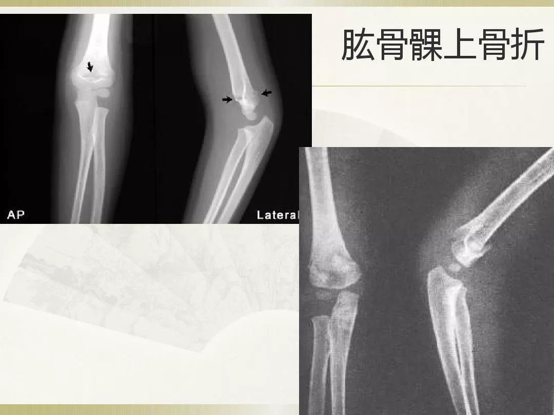 骨科x光片读片技巧,放射科骨科读片教程
